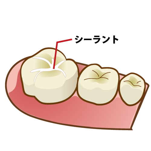 奥歯が生えてきたらシーラントをしてみましょう！