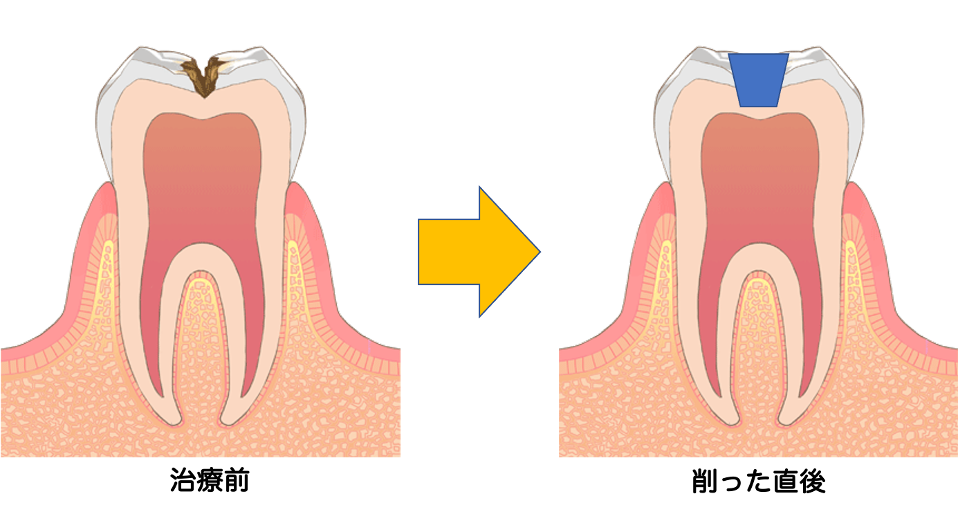 虫歯の治療後なのにしみる・痛い感じがするのはなんで？3