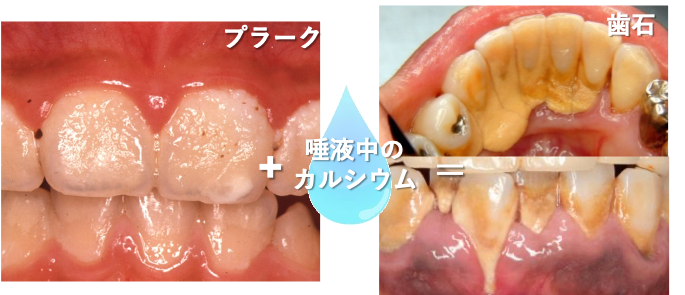 歯石を放置すると・・・歯石にも種類があるのを知っていますか？2