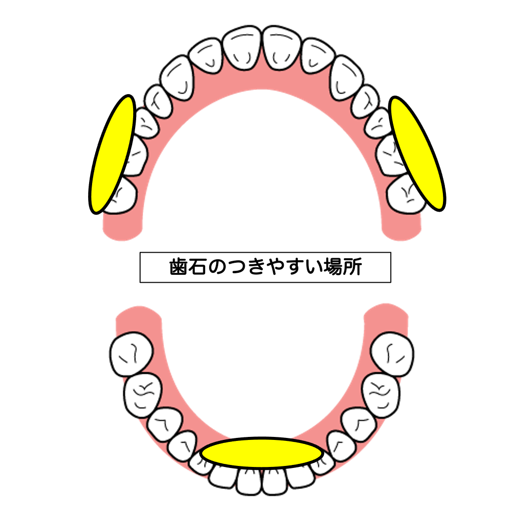 歯石を放置すると・・・歯石にも種類があるのを知っていますか？3