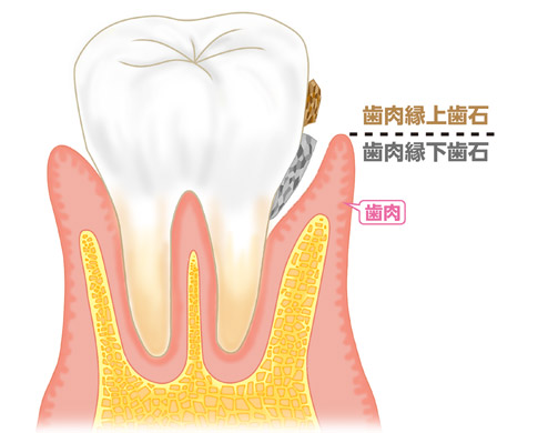 歯石を放置すると・・・歯石にも種類があるのを知っていますか？4