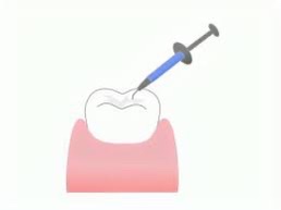 エナメル質形成不全の原因と治療について8