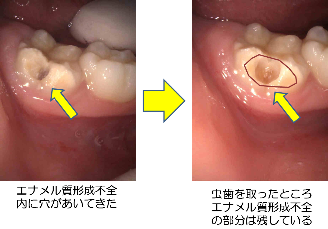 エナメル質形成不全の原因と治療について10