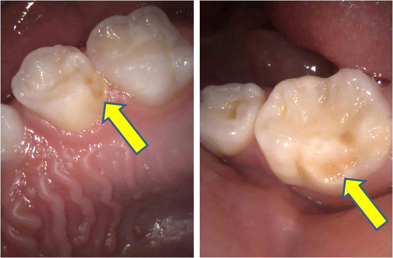 エナメル質形成不全の原因と治療について2