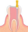 歯の神経を取ったのにどうして痛いの！？
