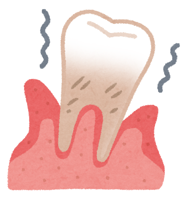 歯周病検査ってどんなことをするの？？